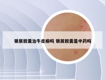 银屑胶囊治牛皮癣吗 银屑胶囊是中药吗