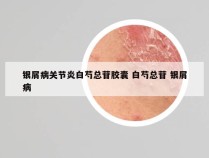 银屑病关节炎白芍总苷胶囊 白芍总苷 银屑病