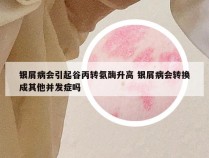 银屑病会引起谷丙转氨酶升高 银屑病会转换成其他并发症吗