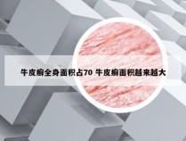 牛皮癣全身面积占70 牛皮癣面积越来越大