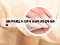 皮肤干燥爱起牛皮癣吗 皮肤干燥爱起牛皮癣吗