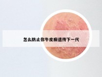 怎么防止你牛皮癣遗传下一代