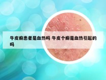 牛皮癣患者是血热吗 牛皮个癣是血热引起的吗