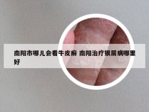 南阳市哪儿会看牛皮癣 南阳治疗银屑病哪里好