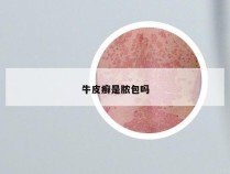 牛皮癣是脓包吗