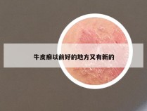 牛皮癣以前好的地方又有新的