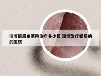淄博银屑病医院治疗多少钱 淄博治疗银屑病的医院
