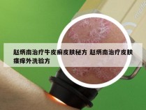 赵炳南治疗牛皮癣皮肤秘方 赵炳南治疗皮肤瘙痒外洗验方