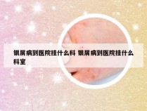 银屑病到医院挂什么科 银屑病到医院挂什么科室