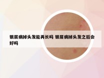 银屑病掉头发能再长吗 银屑病掉头发之后会好吗