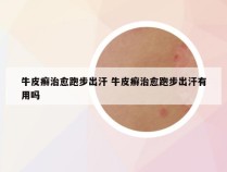 牛皮癣治愈跑步出汗 牛皮癣治愈跑步出汗有用吗