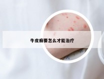 牛皮癣要怎么才能治疗
