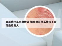 银屑病什么时期传染 银屑病在什么情况下会传染给别人