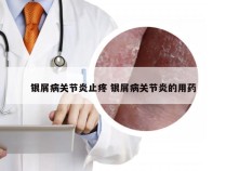 银屑病关节炎止疼 银屑病关节炎的用药