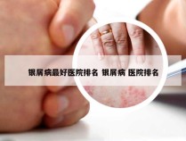 银屑病最好医院排名 银屑病 医院排名