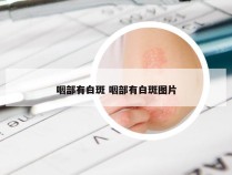 咽部有白斑 咽部有白斑图片