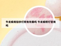 牛皮癣用验钞灯照有效果吗 牛皮癣照灯管用吗