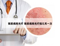 银屑病用光疗 银屑病用光疗隔几天一次