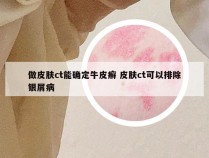 做皮肤ct能确定牛皮癣 皮肤ct可以排除银屑病