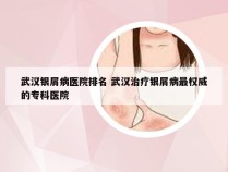 武汉银屑病医院排名 武汉治疗银屑病最权威的专科医院