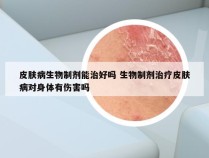 皮肤病生物制剂能治好吗 生物制剂治疗皮肤病对身体有伤害吗