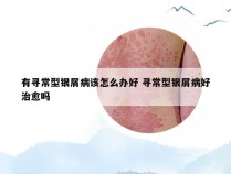 有寻常型银屑病该怎么办好 寻常型银屑病好治愈吗