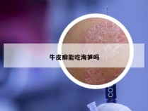 牛皮癣能吃海笋吗