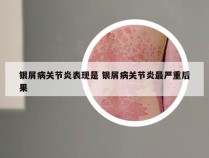 银屑病关节炎表现是 银屑病关节炎最严重后果