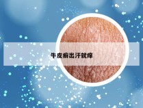 牛皮癣出汗就痒