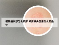 银屑病头部怎么按摩 银屑病头部用什么药最好