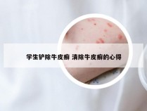 学生铲除牛皮癣 清除牛皮癣的心得
