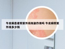 牛皮癣患者照紫外线有副作用吗 牛皮癣照紫外线多少钱