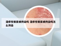 湿疹性银屑病传染吗 湿疹性银屑病传染吗怎么传染