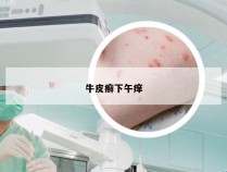 牛皮癣下午痒