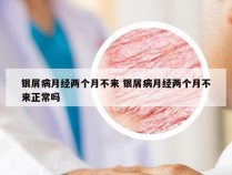 银屑病月经两个月不来 银屑病月经两个月不来正常吗