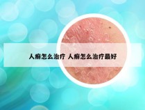 人癣怎么治疗 人癣怎么治疗最好