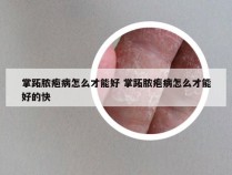 掌跖脓疱病怎么才能好 掌跖脓疱病怎么才能好的快