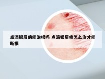 点滴银屑病能治根吗 点滴银屑病怎么治才能断根