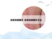 皮肤体癣图片 皮肤体癣图片大全