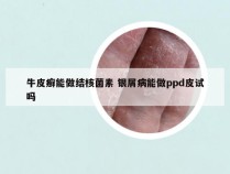牛皮癣能做结核菌素 银屑病能做ppd皮试吗