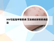 HIV引起指甲银屑病 艾滋病皮肤银屑病感染