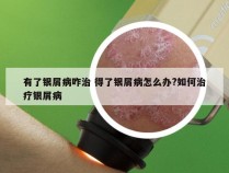 有了银屑病咋治 得了银屑病怎么办?如何治疗银屑病