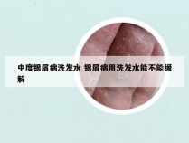 中度银屑病洗发水 银屑病用洗发水能不能缓解