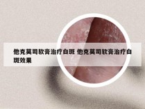 他克莫司软膏治疗白斑 他克莫司软膏治疗白斑效果