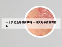 一抺灵能治好银屑病吗 一抹灵对牛皮癣有用吗