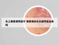 头上银屑病传染不 银屑病会从头部传染全身吗