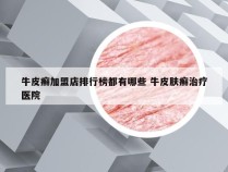 牛皮癣加盟店排行榜都有哪些 牛皮肤癣治疗医院
