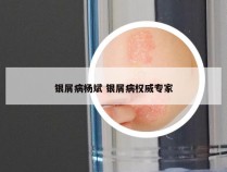 银屑病杨斌 银屑病权威专家