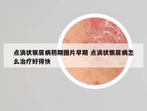 点滴状银屑病初期图片早期 点滴状银屑病怎么治疗好得快
