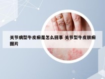 关节病型牛皮癣是怎么回事 关节型牛皮肤癣图片